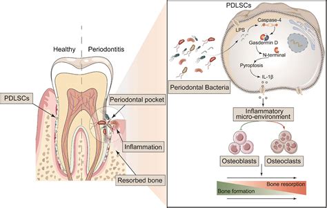 Frontiers Periodontal Inflammation Triggered By Periodontal Ligament Stem Cell Pyroptosis