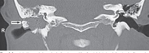 Figure 2 From The Co Existence Of An Osteoma With Cholesteatoma In The