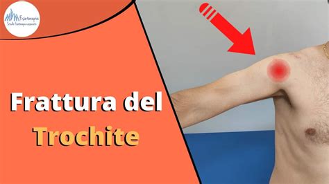 Frattura Trochite Cosa è Fisioterapia e Riabilitazione