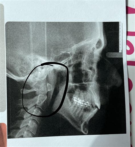 normal neck alignment rmedicaladvice