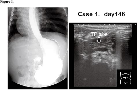 Pyloric Stenosis X Ray