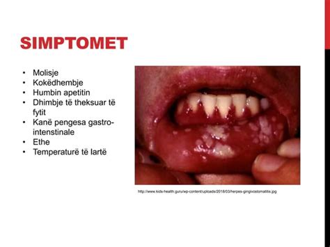 Herpetic Stomatitis PPT