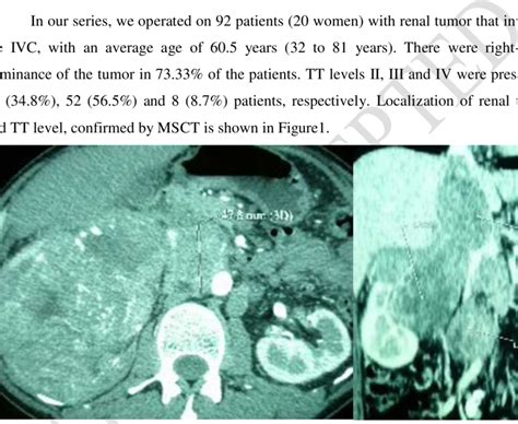 Multi Slice Computed Tomography MSCT Cavography The Inferior Vena