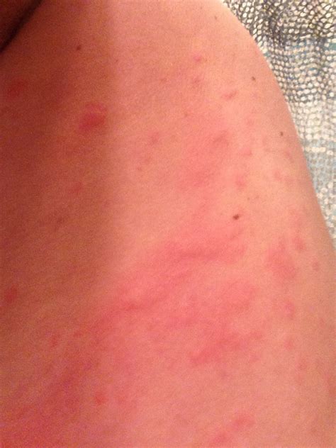 Prednisone Rash