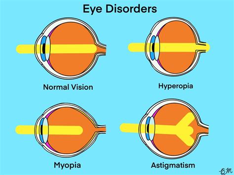 What are Myopia Hyperopia Astigmatism - Khanna Vision Institue