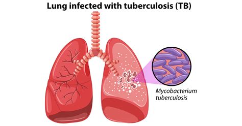 Tuberculosis Symptoms Causes Treatment And Prevention