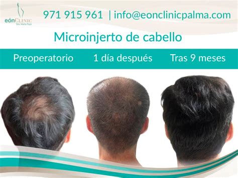 Crecimiento del injerto de pelo Cuánto tarda en crecer el nuevo cabello