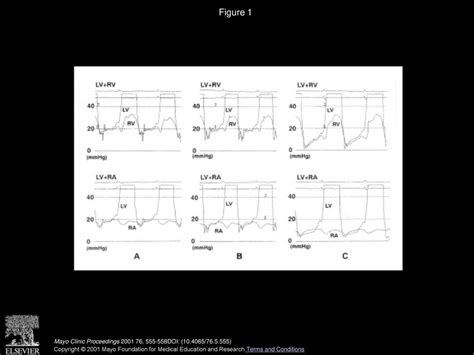 A Case Of Effusive Constrictive Pericarditis After Cardiac Surgery