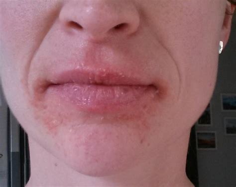 Skin Rash Around Lips | Lipstutorial.org