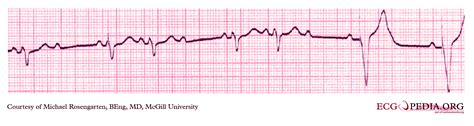 Dual Chamber Pacemaker Ecg