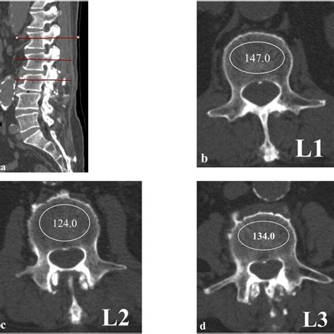 Hounsfield Units Measurement By Drawing Elliptical ROI On Lumbar CT