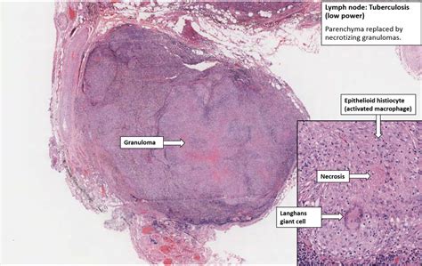 Lung And Lymph Nodes Tuberculosis With Primary Complex Nus Pathweb