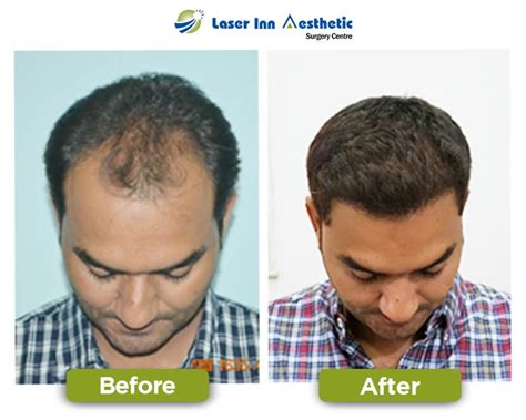 Laser Inn Best Hair Transplant Results Best Fue Hair Transplant