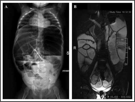 Plain Abdominal X Ray Showing Air Fluid Levels And Dilated Small