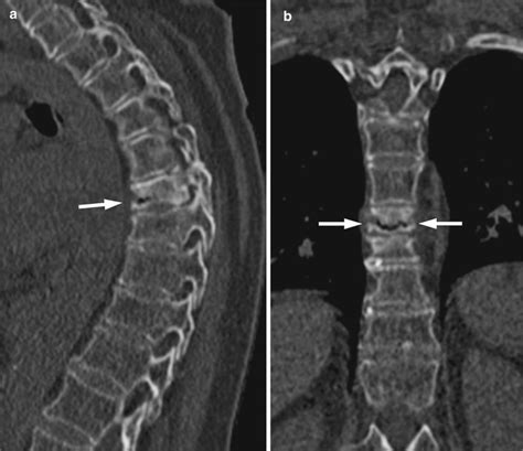 Benign Versus Malignant Vertebral Fractures Radiology Key