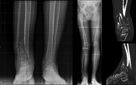 Treatment Of Non Union And Bone Loss Of Tibial Pilon Intechopen