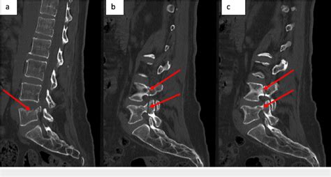 Figure 1 From Bilateral Acute Osteoporotic Lumbar Pedicle Fracture