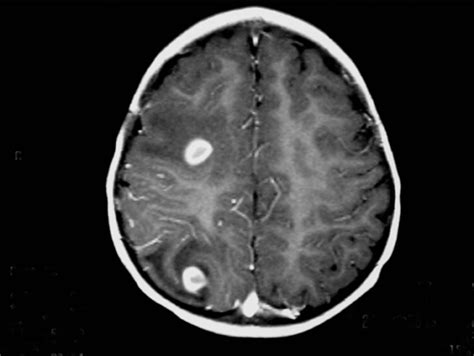 Neurocysticercosis Applied Radiology