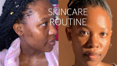 How I Got Rid Of My Acne Within 2 Months Maintaining Clear Skin South African Youtuber