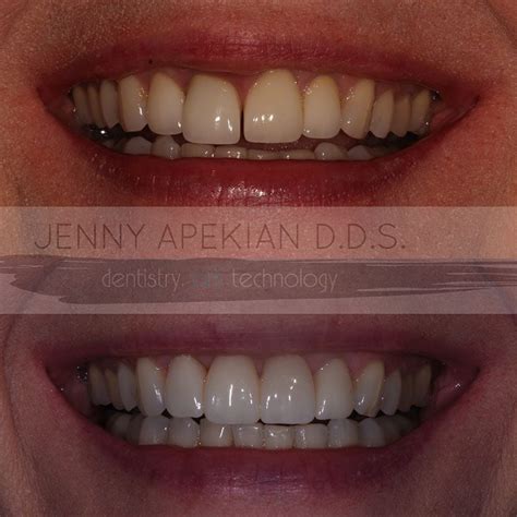 Dental Bridges Before & After Photos - Midtown Dental - Sacramento, CA