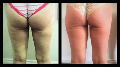 Contouring Cellulite Velashape Iii