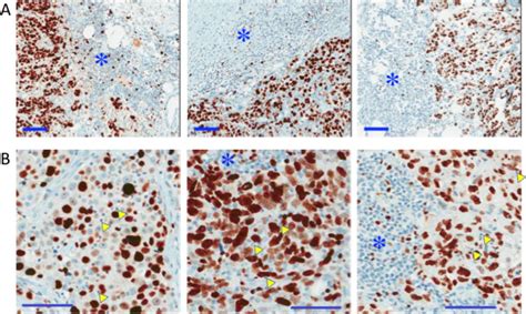 Infiltration Of Cd8 T Cells Into Tumor Cell Clusters In Triple Negative Breast Cancer Biorxiv