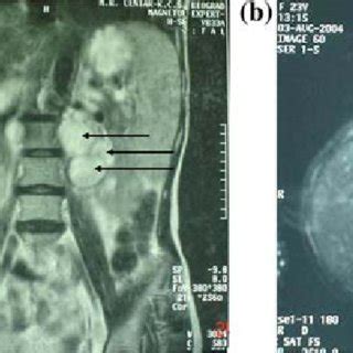 (a, b) MRI characteristics of paraganglioma at diagnosis. Massive... | Download Scientific Diagram