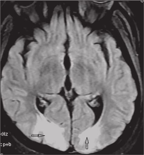 Mri Of Brain Axial Section Showing T2 Hyperintensities In Bilateral Download Scientific