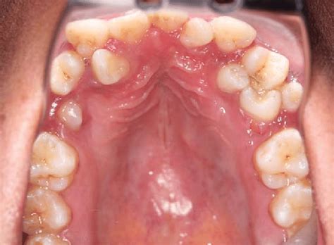 Maxillary Arch Showing Supernumerary Teeth Download Scientific Diagram