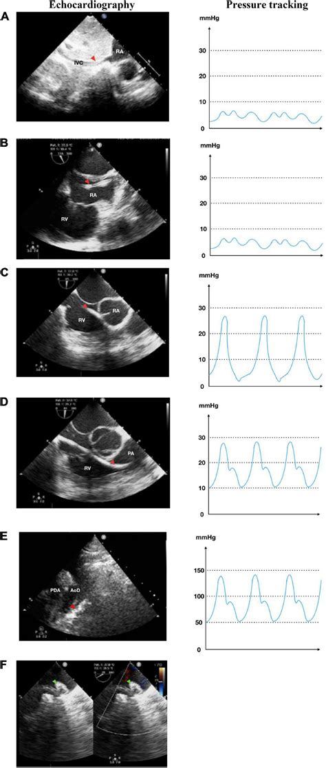 Frontiers Echocardiography Guided Percutaneous Patent Ductus Arteriosus Closure 1 Year Single