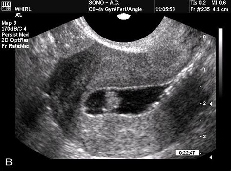 Blood Clot In Uterus During Early Pregnancy Pregnancywalls