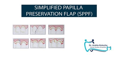 Simplified Papilla Preservation Flap Sppfminimally Invasive