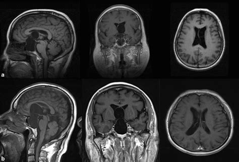 A B Preoperative Brain MRI Scans Of Cases 2 And 21 Show Suprasellar