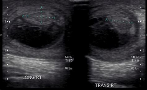 Scrotal Anatomy Ultrasound