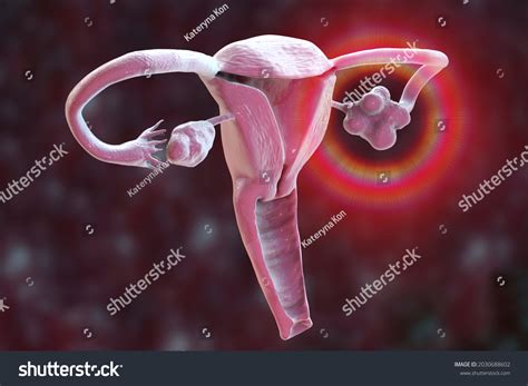 Polycystic Ovary Syndrome 3d Illustration Showing Stock Illustration