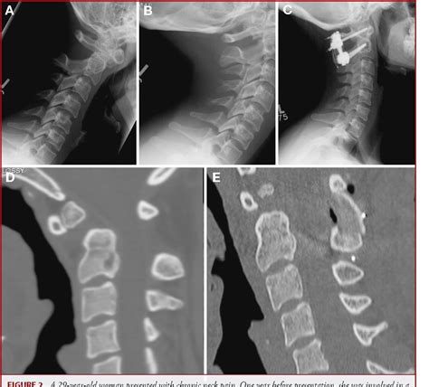 Os odontoideum | Semantic Scholar