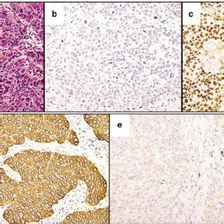 Poorly differentiated squamous cell carcinoma. Representative images of ...