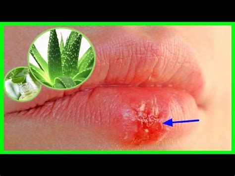 Como Eliminar Herpes Labial Con S Bila O Aloe Vera Youtube