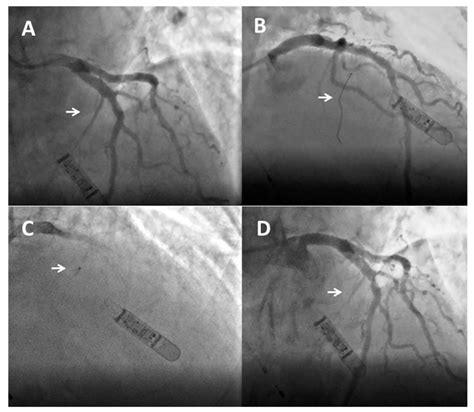 Angiographic Sequence Of Alcohol Septal Ablation A Baseline