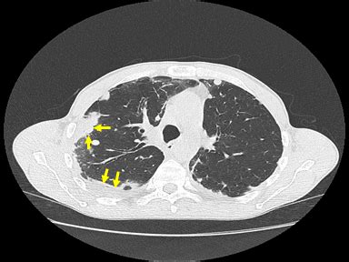 Mediastinal mass differential diagnosis - wikidoc