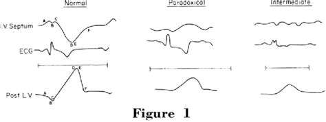 Paradoxical Motion Of Interventricular Septum In Left Bundle Branch