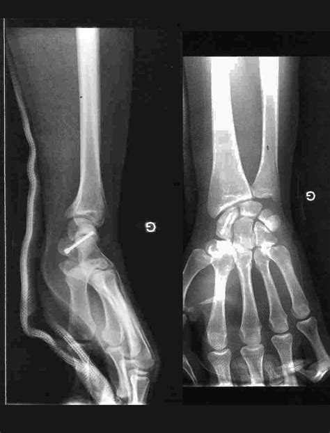 Fracture du scaphoïde Bordeaux Institut Aquitain De La Main