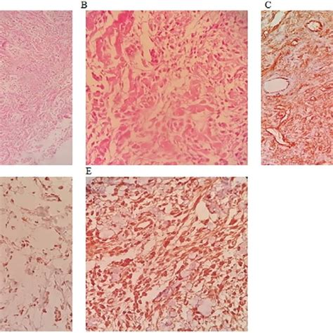 A Solitary Fibrous Tumor Of Breast A Low Power Hande View B High