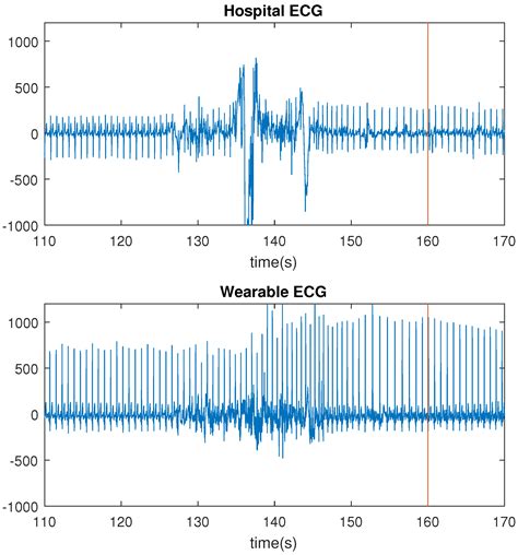 Sensors Free Full Text Automated Epileptic Seizure Detection Based