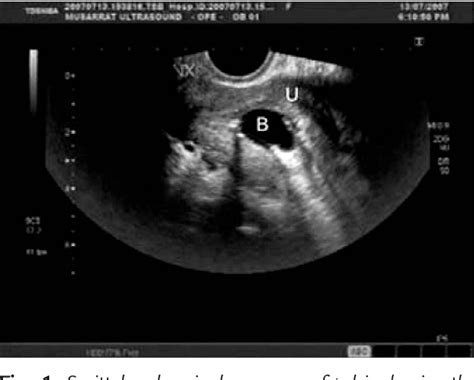 Figure 1 from Diagnosis of Pyosalpinx by Hysterosalpingosonography ...