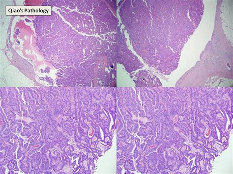 Qiao S Pathology Encapsulated Intracystic Or Encysted Papillary