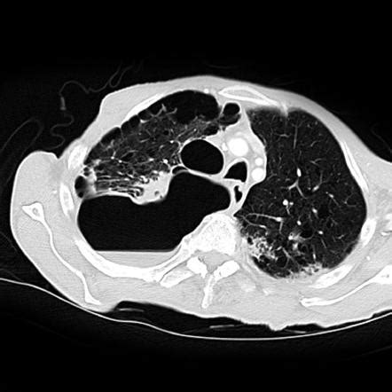 Loculated pneumothorax | Radiology Reference Article | Radiopaedia.org