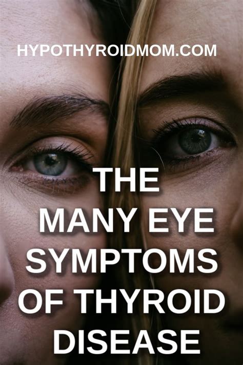 Eye Symptoms In Hypothyroidism