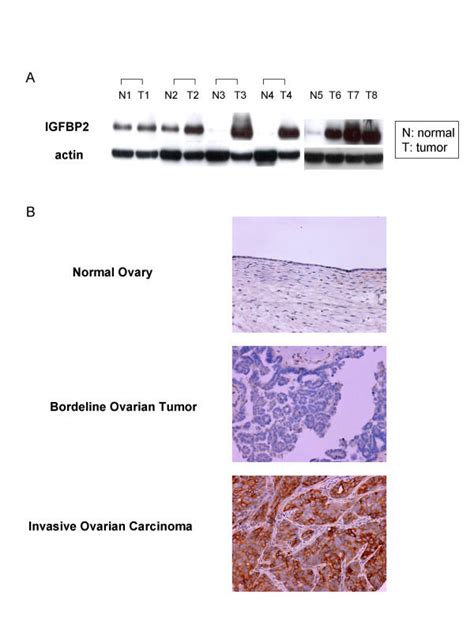 Overexpression Of IGFBP2 In Ovarian Carcinoma A Western Blotting