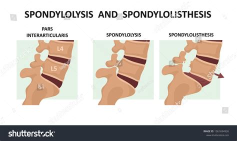 Spondylolisthesis Images Browse 778 Stock Photos Vectors Free